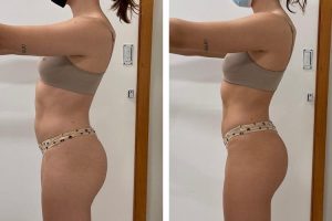 oxandrolona-antes-e-depois11